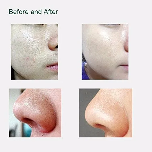 #1 SELLING BLACK HEAD ELIMINATOR