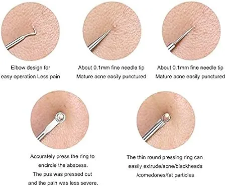 Abhijeet enterprises Stainless Steel Blackhead Remover Pimple Blemish Extractor Remover Tool Set of 4
