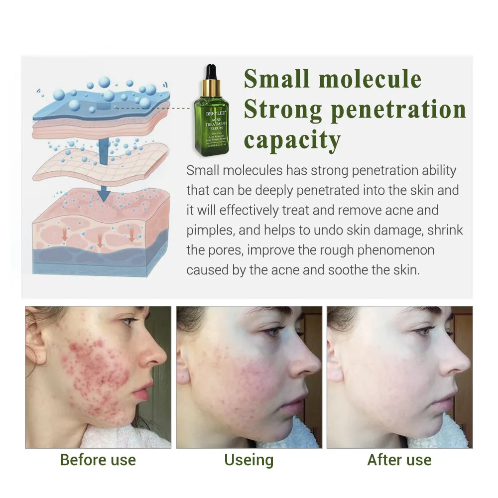 Acne Pimple Patch Face Mask Skin Care Serum Face Cream Mask Facial Care Tools