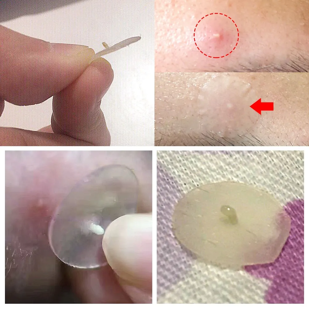 Acne Pimple Patch Face Mask Skin Care Serum Face Cream Mask Facial Care Tools