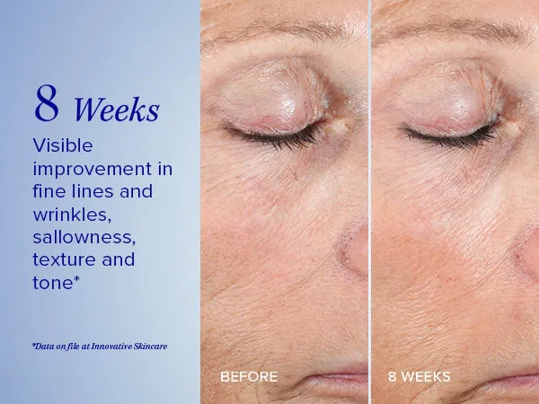 Active Peel System
