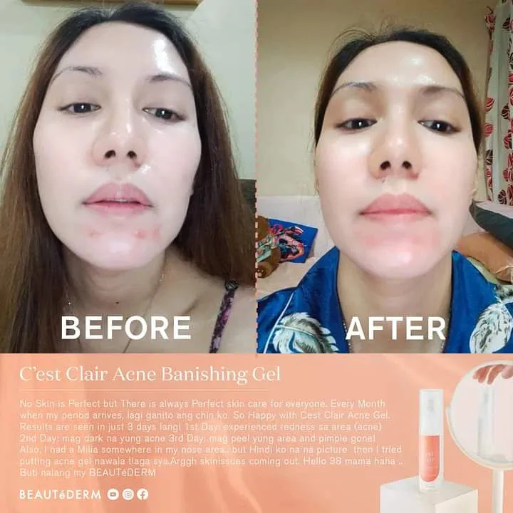 Beautederm - C’est Clair - Blemish Banishing Gel - Acme Drying Gel 30 ml