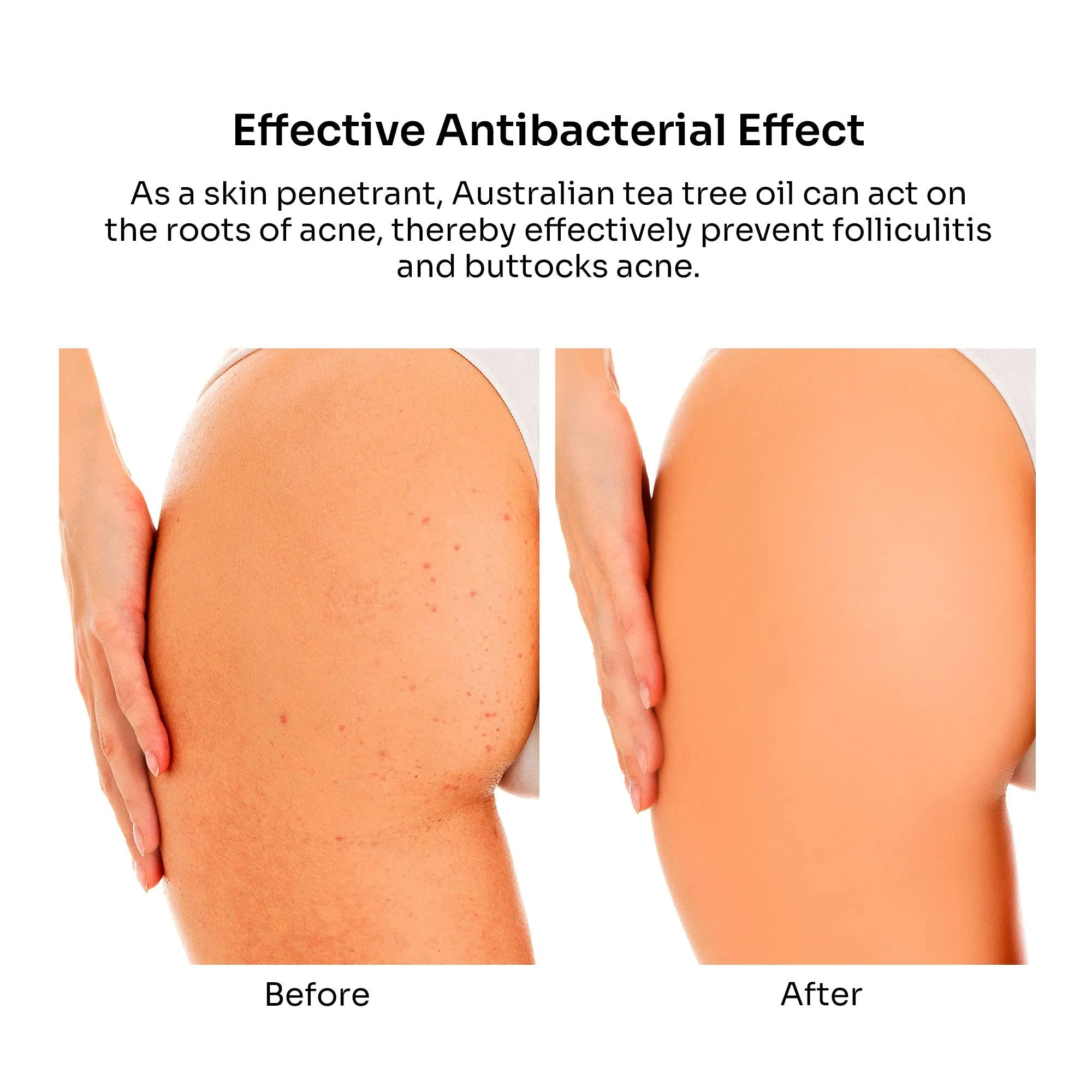 BellamiLuxx Butt Acne Clearing Treatment: with 2% Salicylic Acid and Tea Tree Oil, Effective Body Acne Treatment and Folliculitis Treatment, Butt Acne Cream for Reduce Body Acne