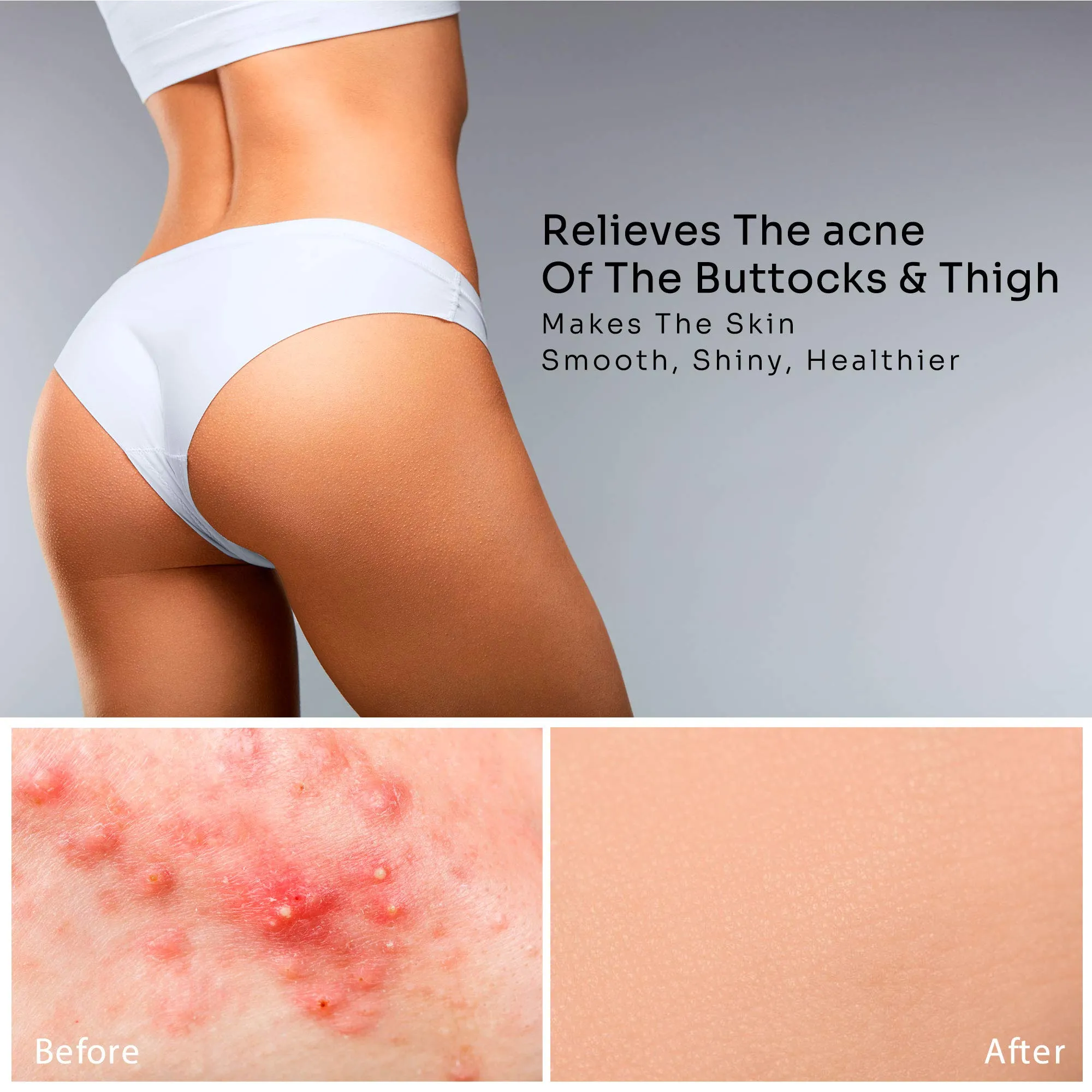 BellamiLuxx Butt Acne Clearing Treatment: with 2% Salicylic Acid and Tea Tree Oil, Effective Body Acne Treatment and Folliculitis Treatment, Butt Acne Cream for Reduce Body Acne