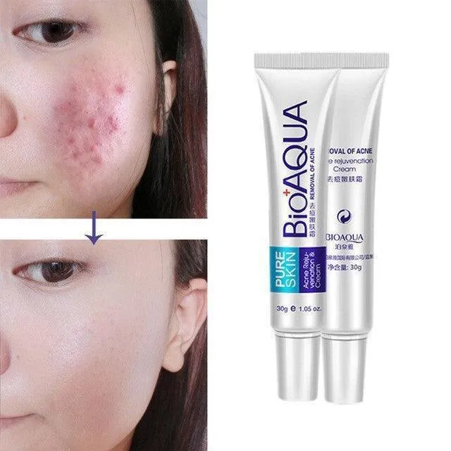 Bioaqua face cream skin care anti acne treatment cream 30g -100% ORIGINAL