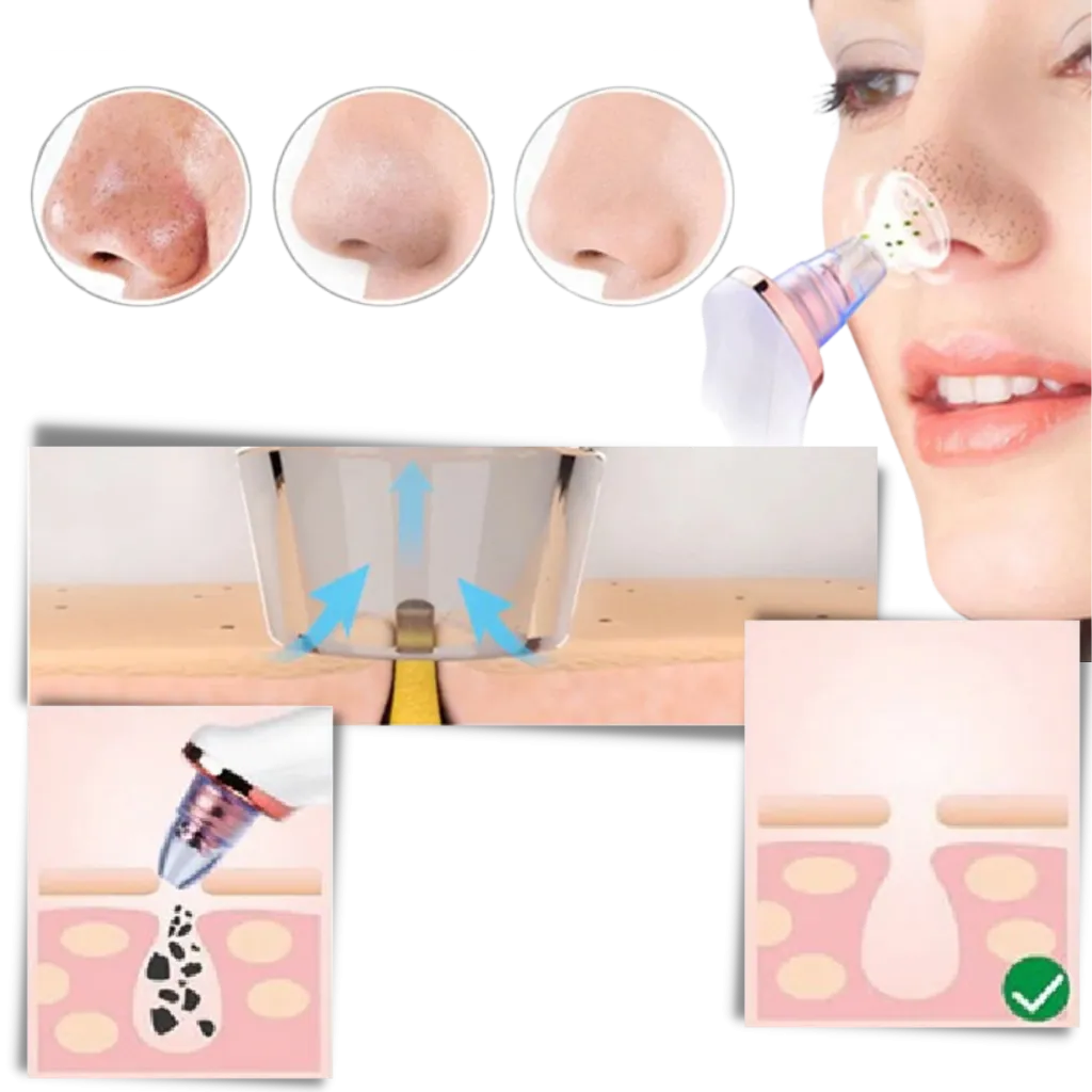 Blackhead Pore Remover Vacuum