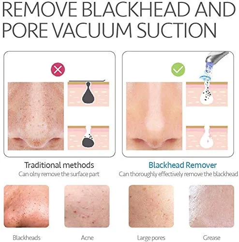 Blackhead Remover Comodo Pore Vacuum Cleaner with Rechargeable Base and Four Interchangeable Heads 2020 Upgraded Acne Extractor Tool Machine