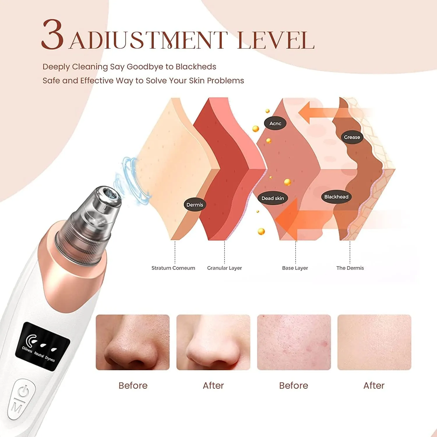 Blackhead Remover Pore Vacuum,Upgraded Facial Pore Cleaner-5 Suction Power,5 Probes,USB Rechargeable Blackhead Vacuum Kit Electric Acne Extractor Tool for Women & Men