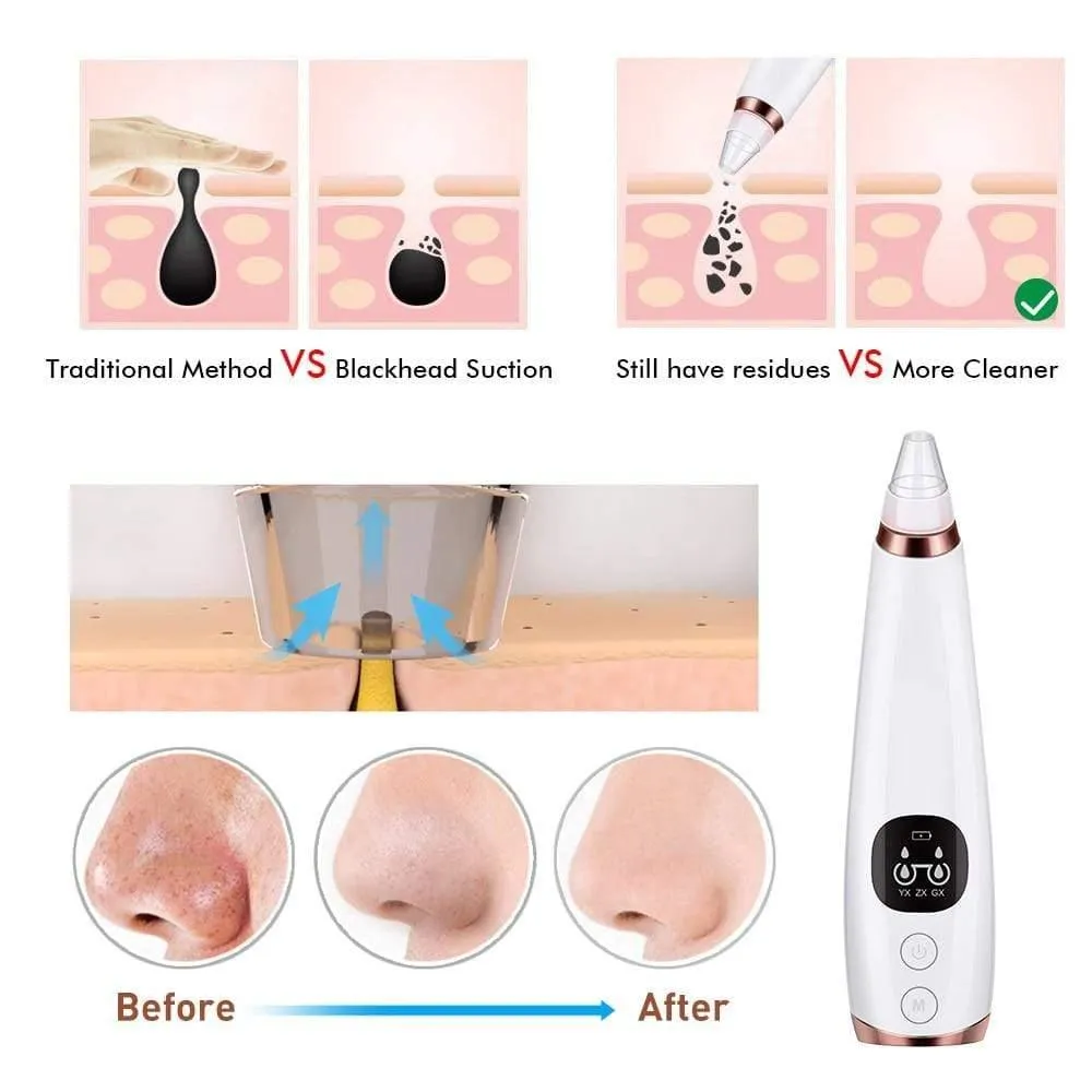 Blackhead Remover Vacuum Pore Cleaner