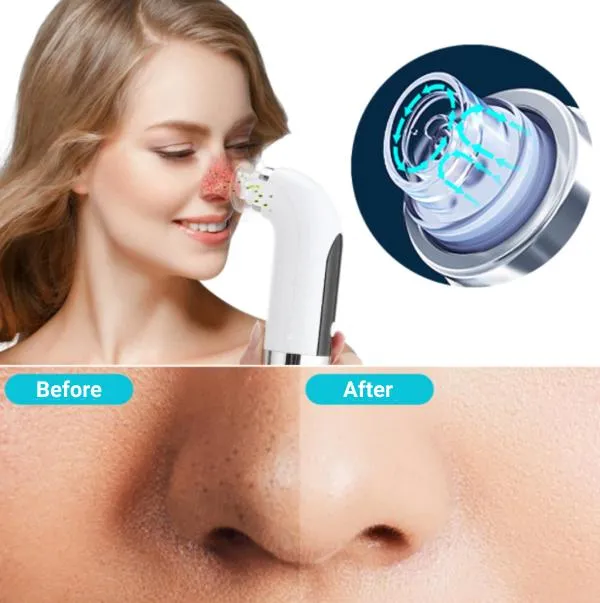 Blackhead Vacuum Facial Cosmetic Tool