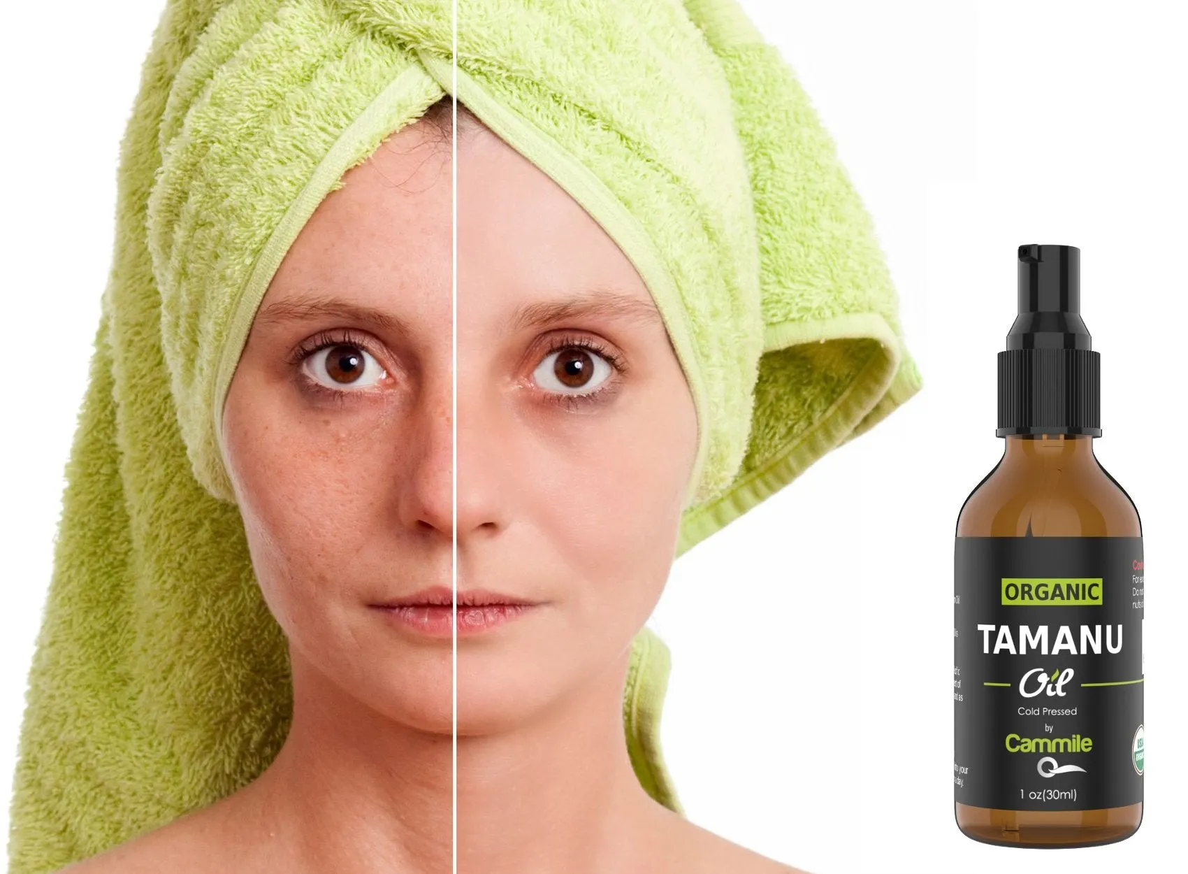 Cammile Q Organic Tamanu Oil - Natural Psoriasis Treatment - Great For Eczema, Acne & Scars - Cold Pressed