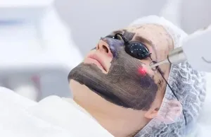 Carbon Facial (Hollywood Peel)