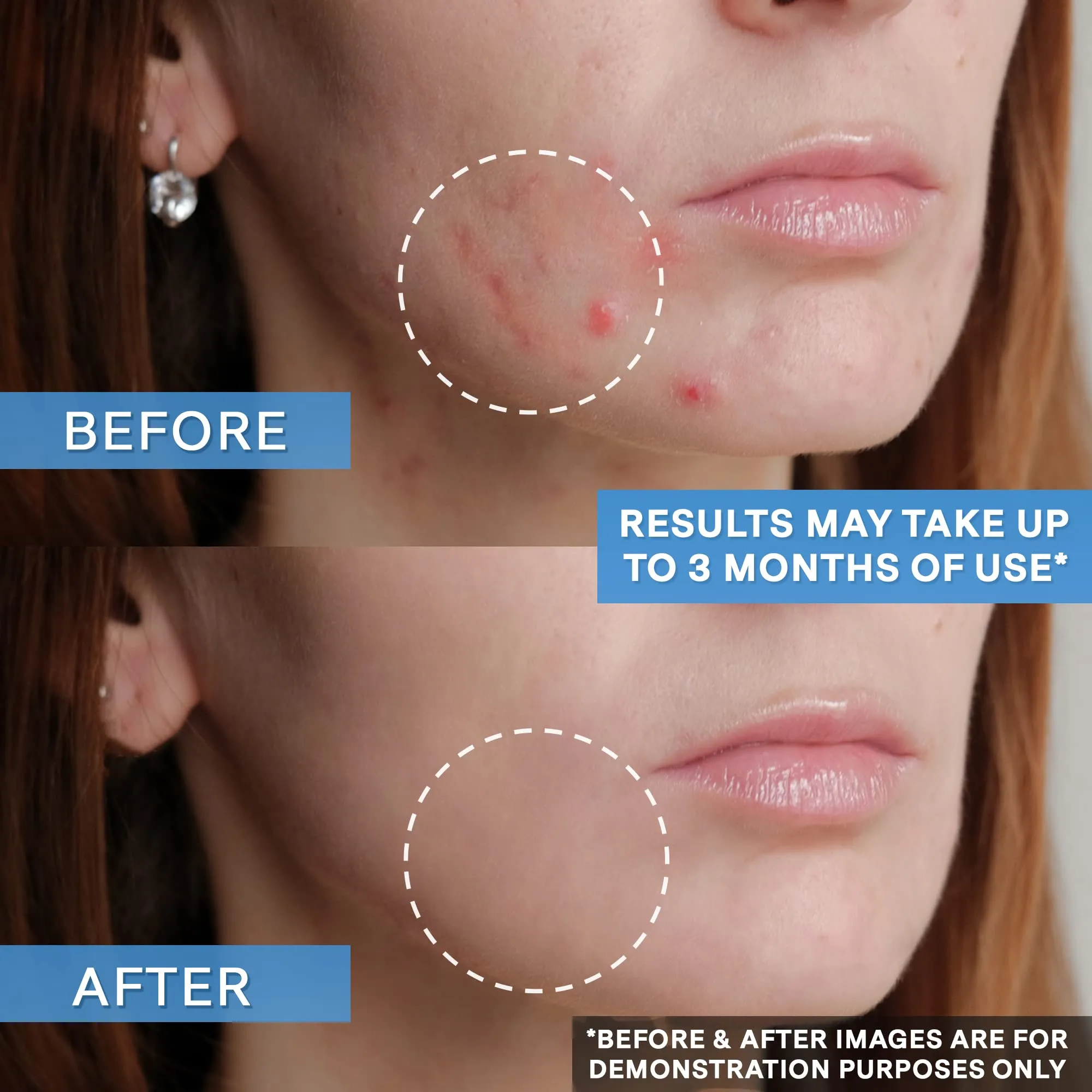 Curist Adapalene 0.1% Acne Gel Topical Retinoid Acne Medicine - Prevent Acne, Whiteheads, Blackheads, & Clogged Pores - Adapalene Retinoid Acne Treatment For Face (2 Pack)