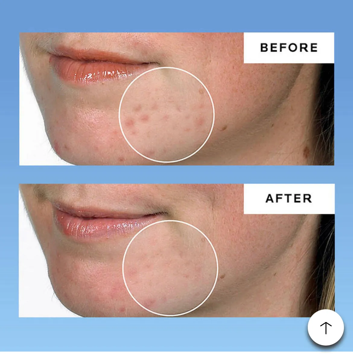 LA ROCHE POSAY  Effaclar Dermatological Acne 3-Step System بكج معالج حب الشباب
