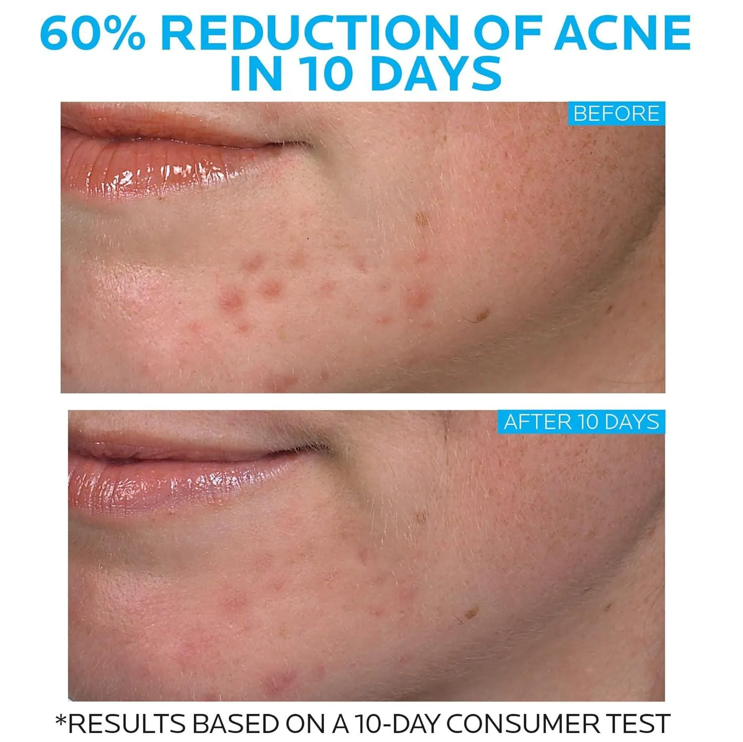 La Roche Posay - Effaclar Duo Dual Action Acne Treatment - 20ml
