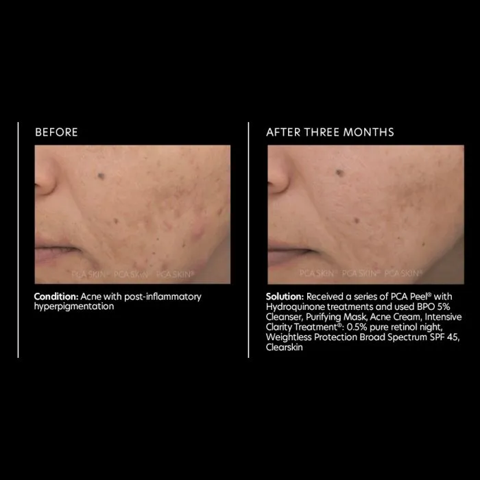 PCA Acne Cream