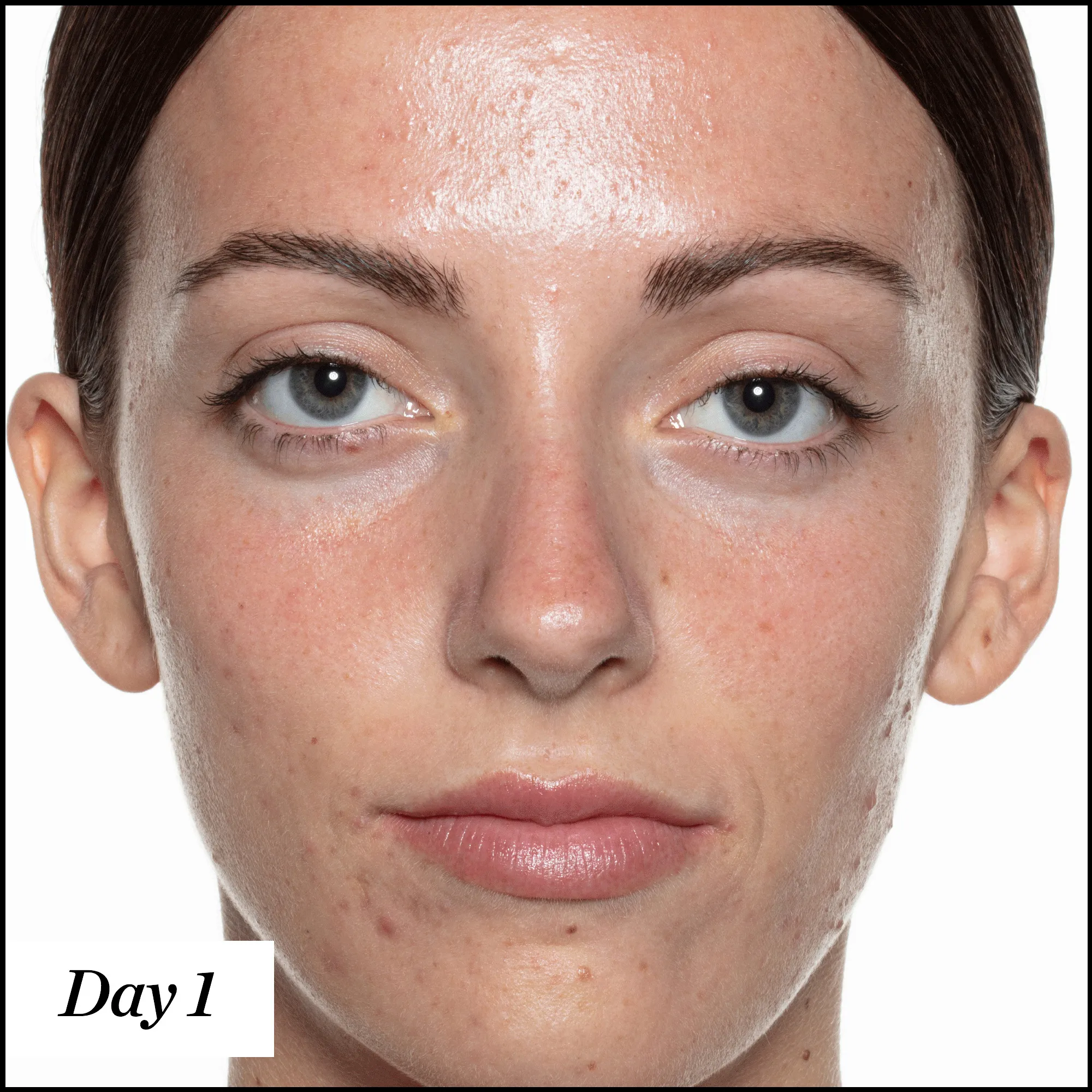 U.F.O. Acne Treatment Face Oil