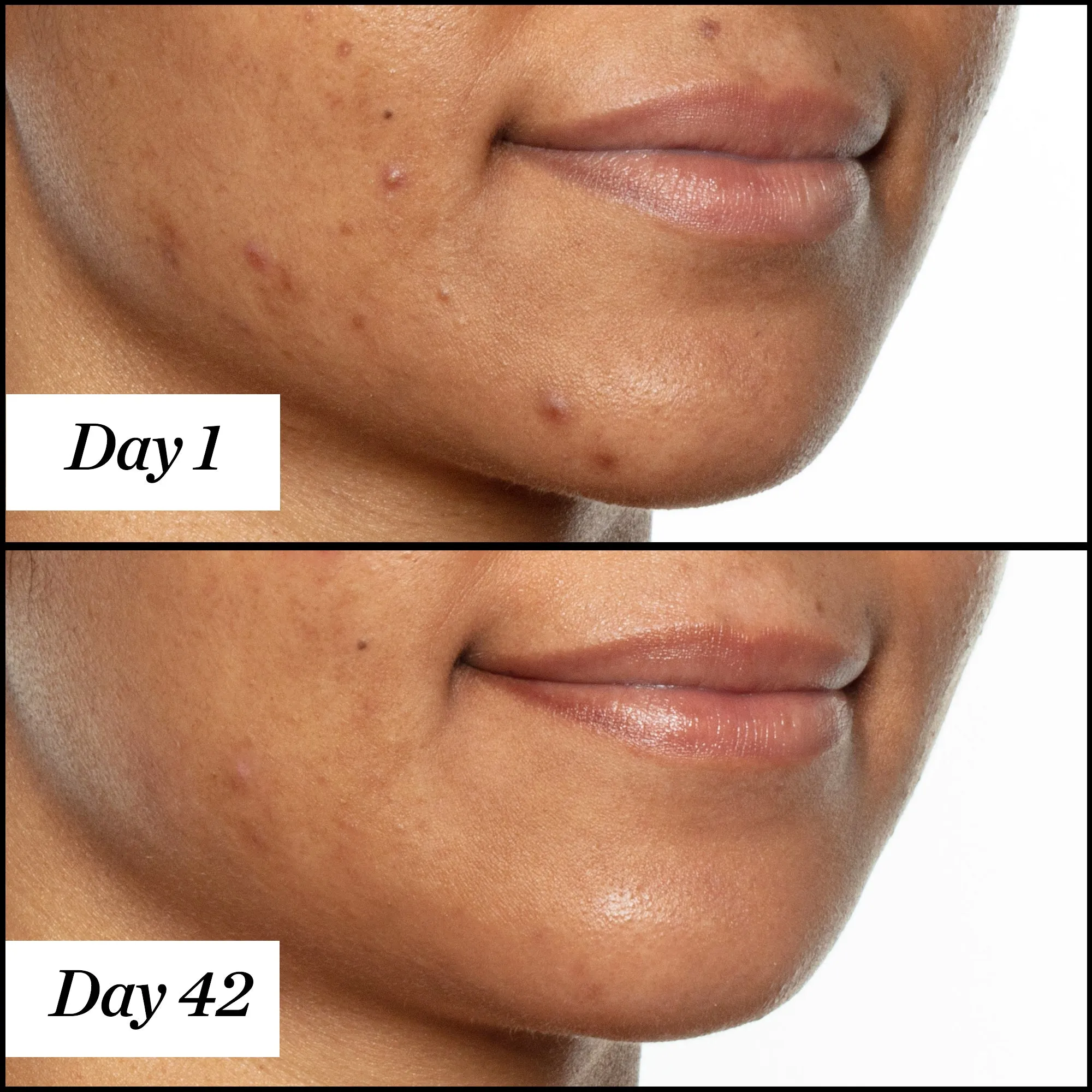 U.F.O. Acne Treatment Face Oil