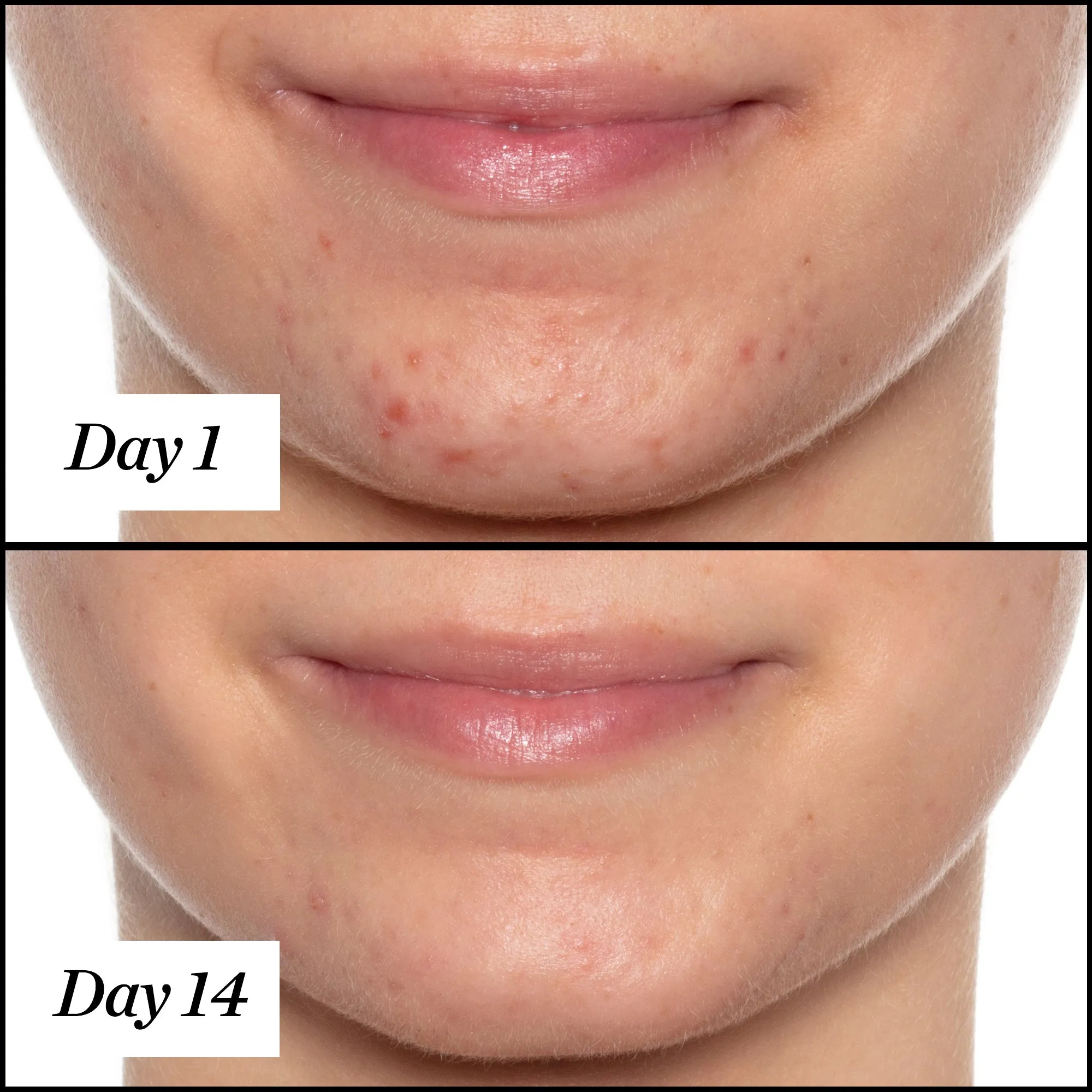 U.F.O. Acne Treatment Face Oil