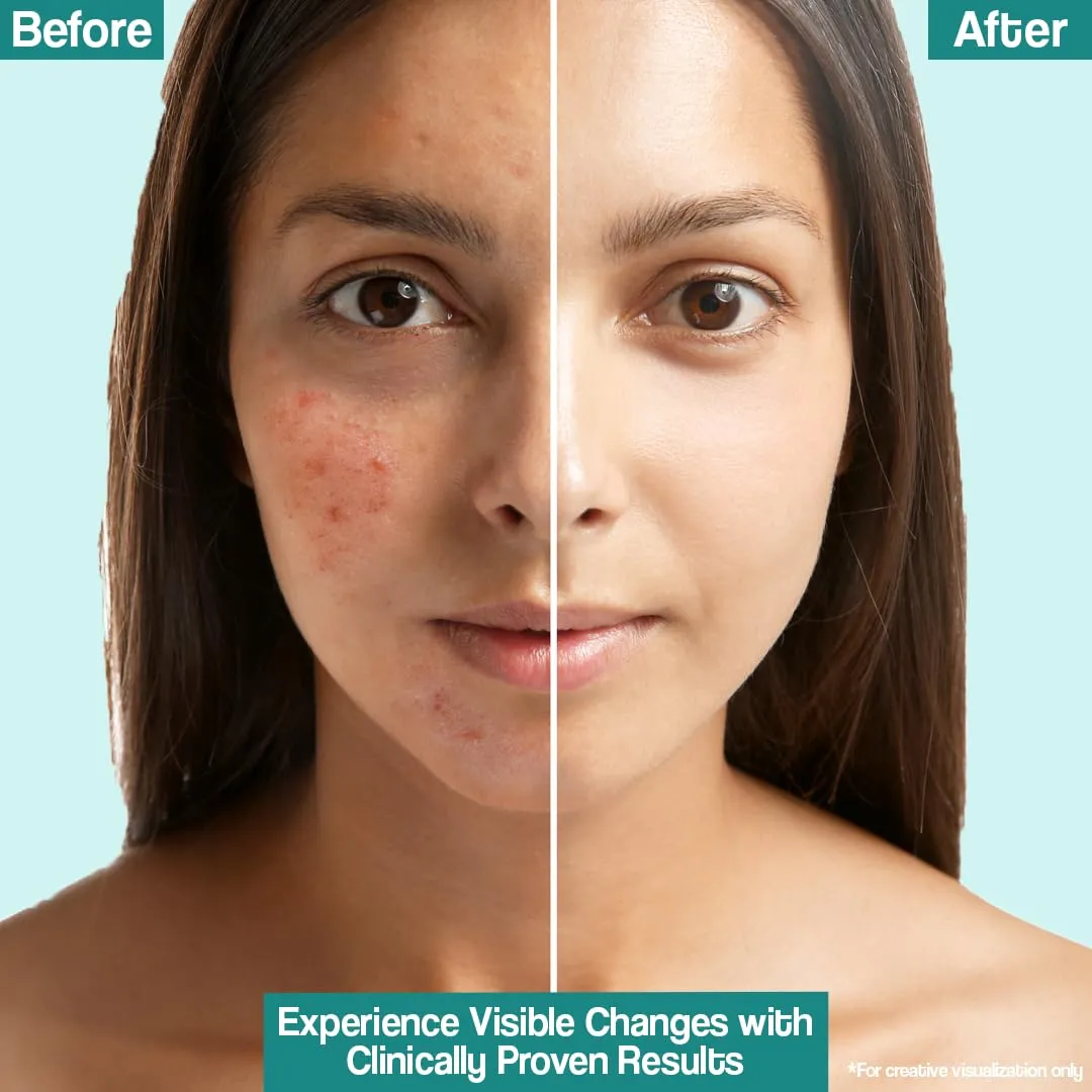 Venusia Acne Lotion 75gm