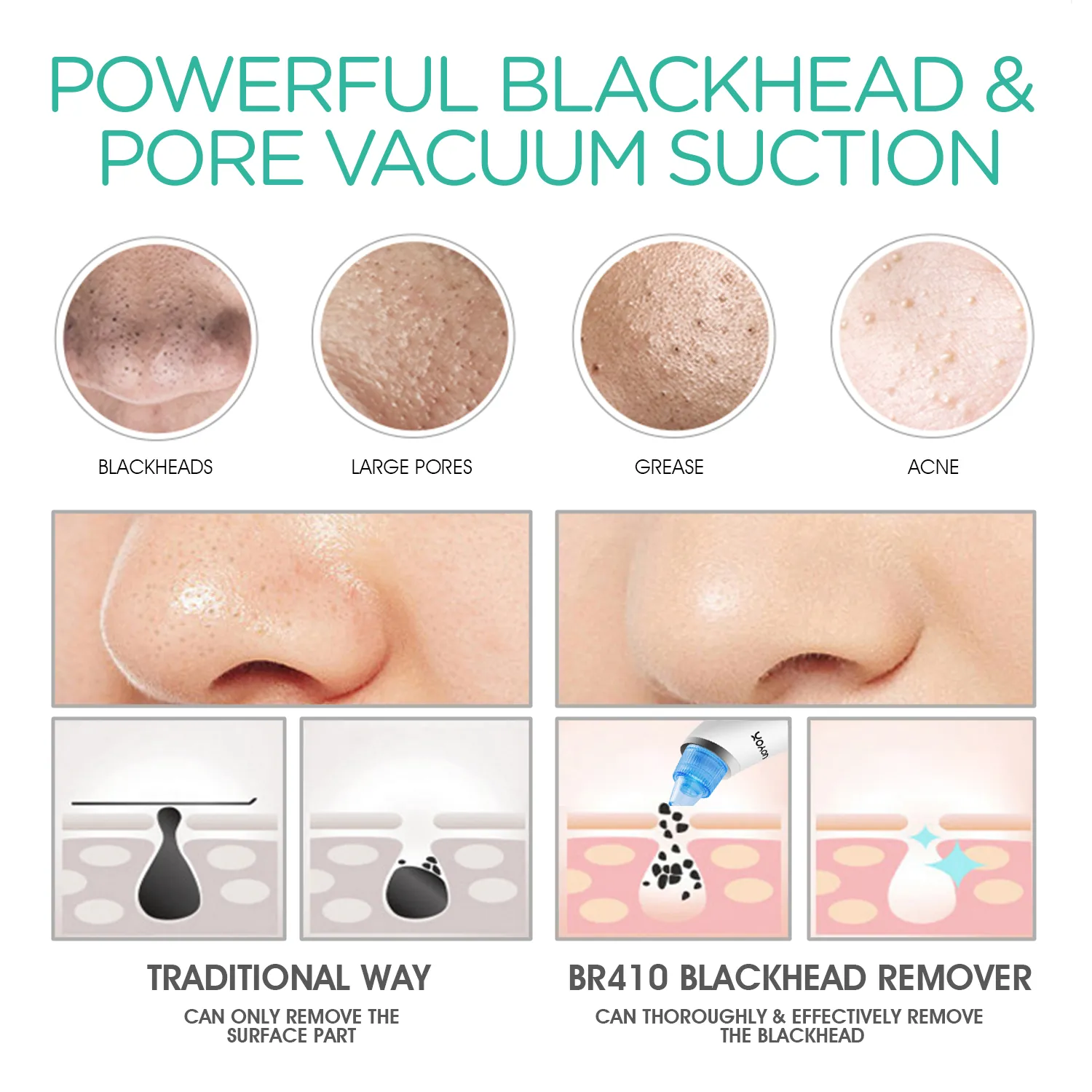 VOYOR blackhead remover-pore vacuum cleanser BR410