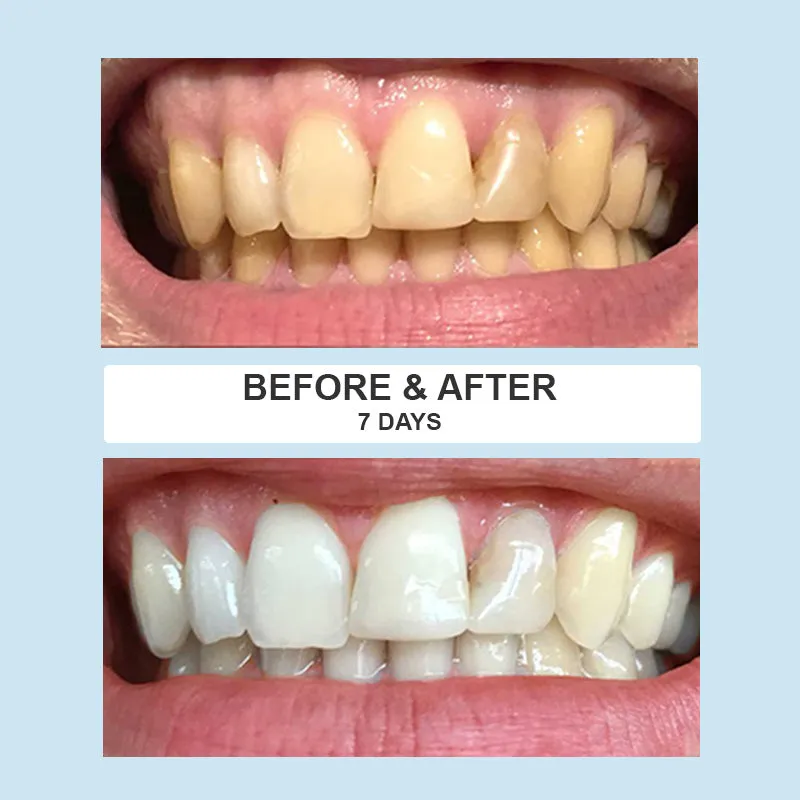 Whitening Pen Pack